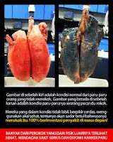 Image Cara Mengobati Infeksi Paru-Paru Paling Terbaik